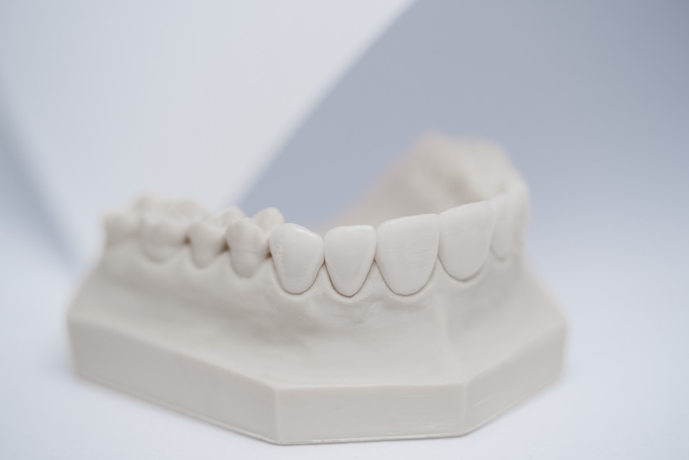 zahnarzt-muenchen-lehel-veneers-1 zahnarzt-muenchen-lehel- veneers-1