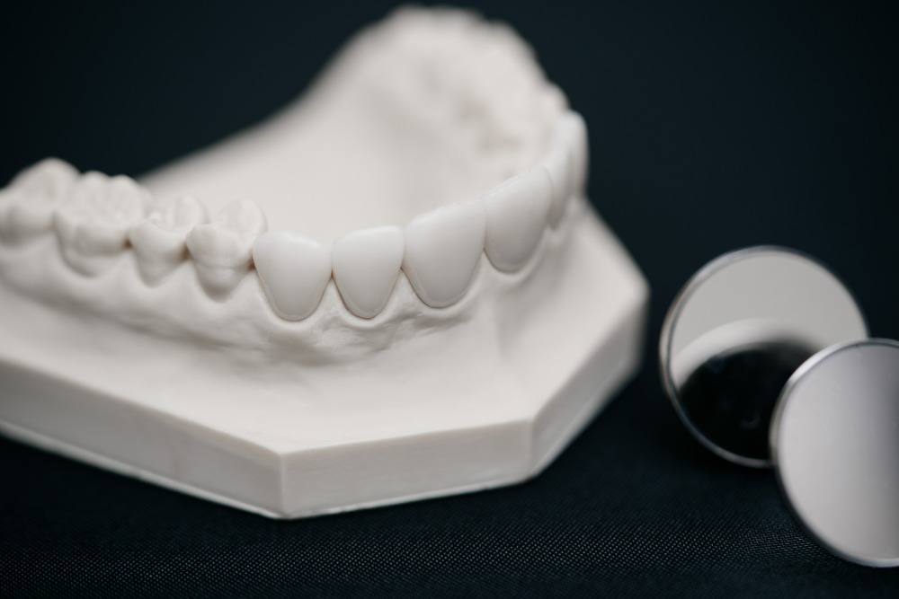 zahnarzt-muenchen-lehel-veneers-2 zahnarzt-muenchen-lehel- veneers-2