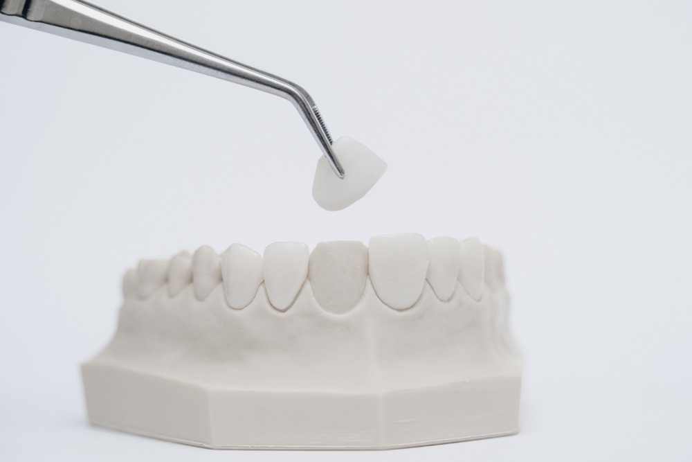 zahnarzt-muenchen-lehel-veneers-3 zahnarzt-muenchen-lehel- veneers-3