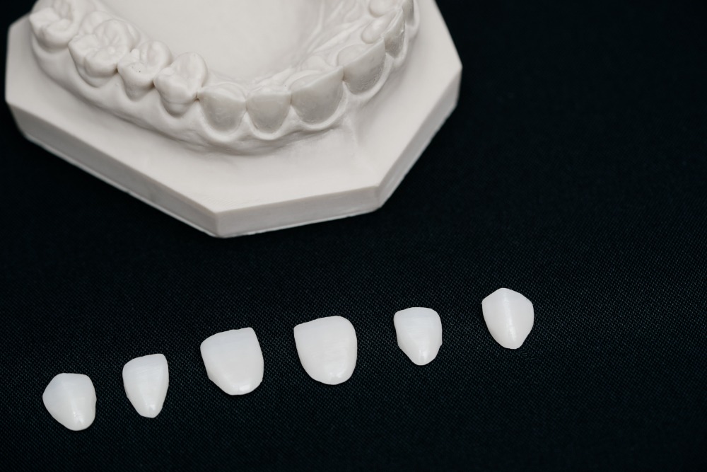 zahnarzt-muenchen-lehel-veneers-4 zahnarzt-muenchen-lehel- veneers-4